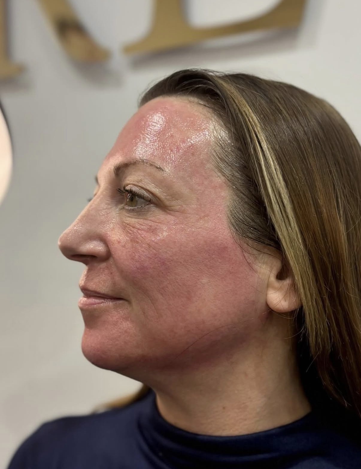Post-treatment glow